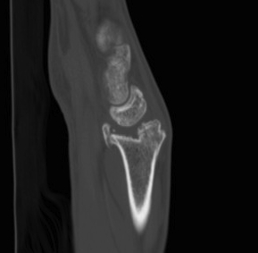 Distal Radial Step OA